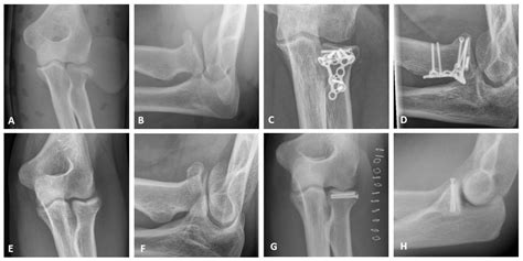 JCM | Free Full-Text | Functional Postoperative Outcome for 92 Cases of Radial Head Fractures: A ...