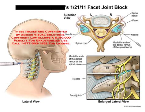 AMICUS Illustration of amicus,medical,spine,facet,joint,block,spinal ...