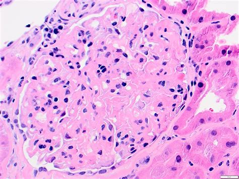 Membranoproliferative Glomerulonephritis