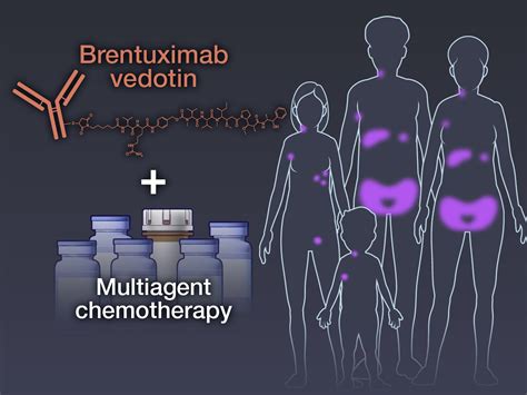 NEJM on Twitter: "In high-risk Hodgkin’s lymphoma, brentuximab vedotin ...