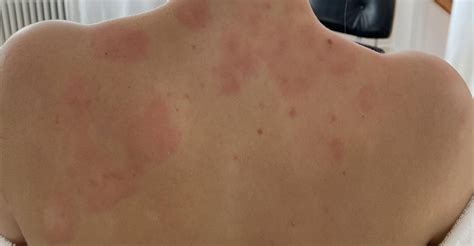 Adbry side effects (Hives?) : r/eczeMABs