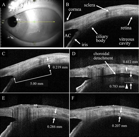 Representative anterior segment optical coherence tomographic (OCT ...