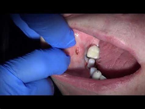 Oral fibroma removal. Dental surgery in Los Angeles Dentistry - U 818.776.0055 - YouTube