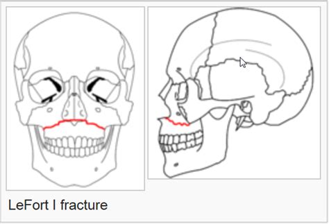 Facial Fracture Management Handbook - LeFort Fractures | Iowa Head and Neck Protocols