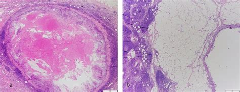 Biopsy clip site may be identified inside (a) or outside (b) the ...