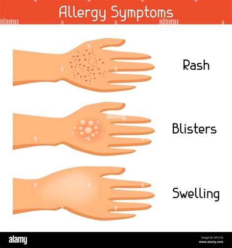 Allergy symptoms. Vector illustration for medical websites advertising medications Stock Vector ...