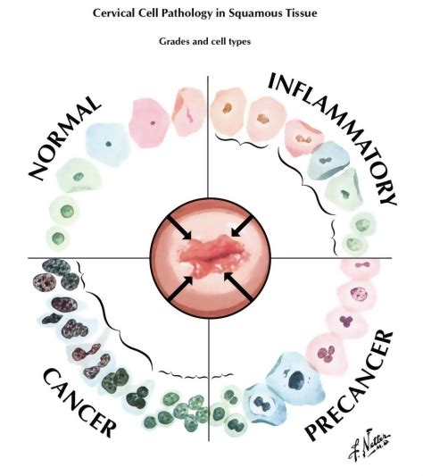 Abnormal Pap Smear: ASCUS or AGCUS Cervical Cell Pathology in Squamous ...