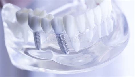 Dental teeth mouth model stock image. Image of medicine - 105525465