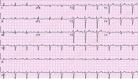 Ecg Sinus Rhythm First Degree Av Block Intraventricular Conduction | The Best Porn Website