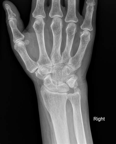 Triquetral fracture - pooping duck sign | Image | Radiopaedia.org