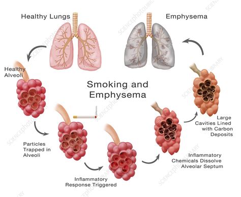 Lung Damage and Emphysema, Illustration - Stock Image - C027/6692 ...