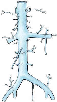 Inferior vena cava syndrome - Wikiwand