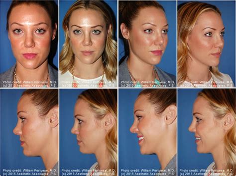 Flat Nose Before and After Photo Gallery - Nose Surgery Photos