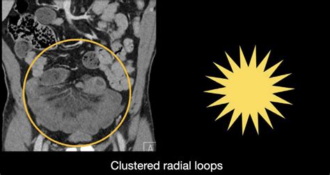 Abdominal CT: closed loop • LITFL • Radiology Library