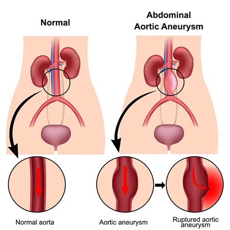 Thoracic Aortic Aneurysm Classification