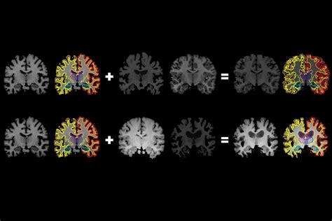 From one brain scan, more information for medical artificial ...