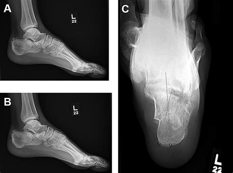 Anterior Calcaneus Fracture