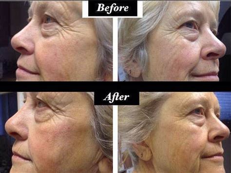 Microcurrent Facial Treatment Before And After (1) » Facelift: Info, Prices, Photos, Reviews, Q&A