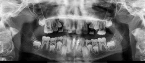 Central Giant Cell Granuloma Mandible