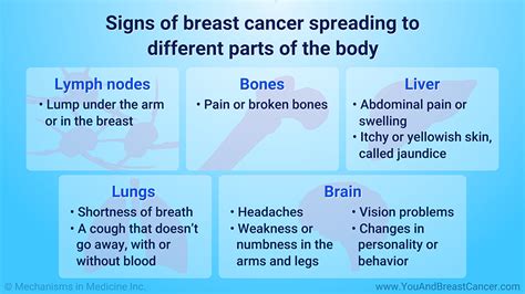 Slide Show - Understanding Metastatic Breast Cancer