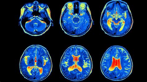 Brain Scans Could Help People With Bipolar Disorder Get The Treatment They Need | IFLScience