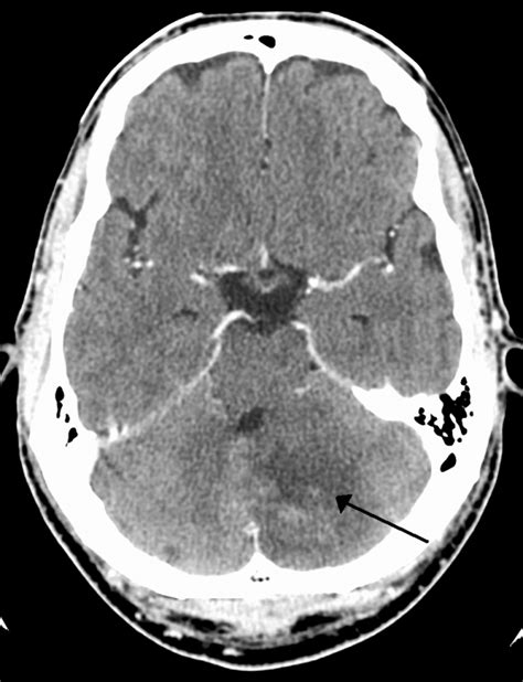 Cerebellar stroke - WikEM