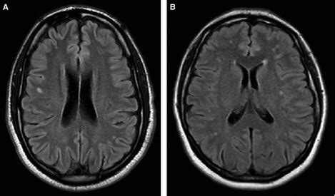 White matter lesions and migraine. Typical brain MRI images showing... | Download Scientific Diagram