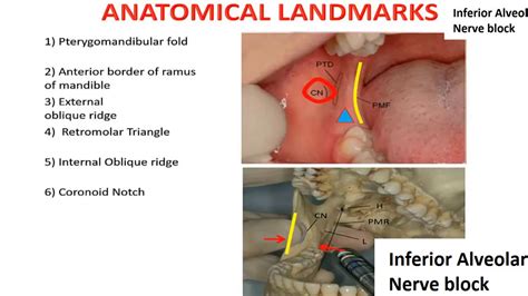 Inferior Alveolar Nerve Block Anatomical Landmarks