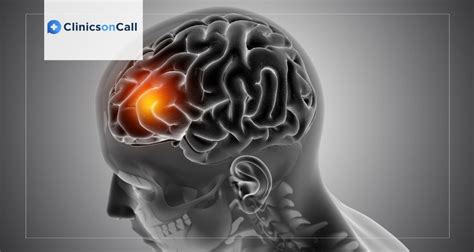 Medulloblastoma Treatment Methods in Foreign Clinics - Clinics on Call