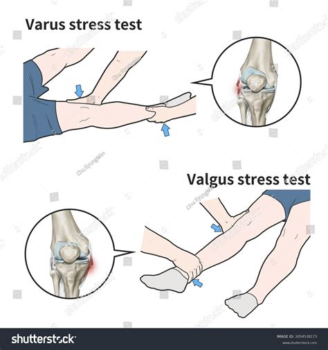 3d Medical Illustration Explain Varus Valgus Stock Illustration 2054538173 | Shutterstock