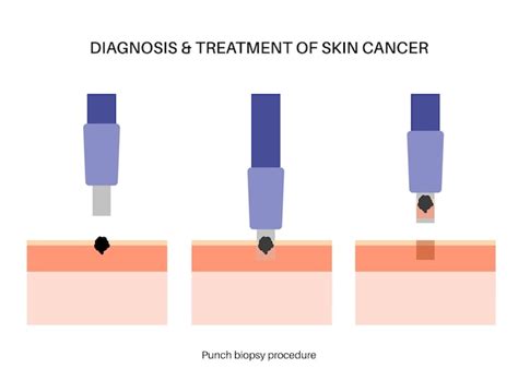 Premium Vector | Punch biopsy procedure