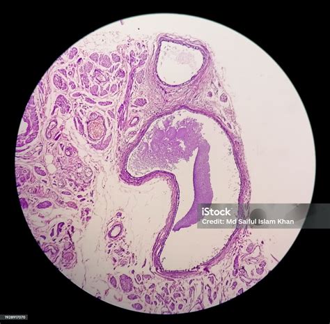 Histology Peritoneal Inclusion Cyst Paraovarian Cysts Hydrosalpinx And Lowgrade Cystic ...