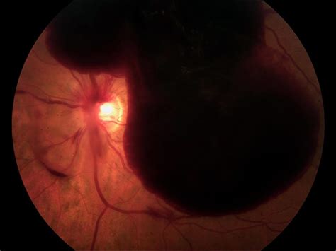 Diabetic Retinopathy Livingston | Diabetic Eye Disease Morristown, NJ