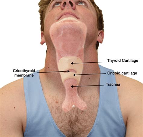 Cricothyrotomy