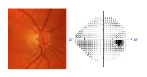 Stages of Glaucoma Progression | Glaucoma Australia