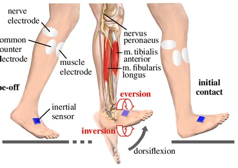 Drop foot treatment by functional electrical stimulation of the nerve... | Download Scientific ...