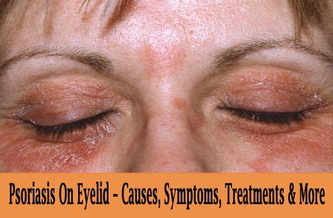 Psoriasis On Eyelid – Causes, Symptoms, Treatments & More | Psoriasis ...