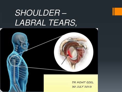 Anatomy Of Shoulder Labral Tear