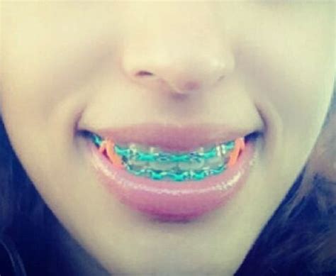 green teal braces colors - Dena Bundy