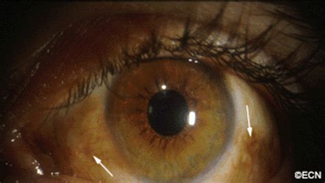 Pigmented Conjunctival Cancers (Primary Acquired Melanosis) » New York ...