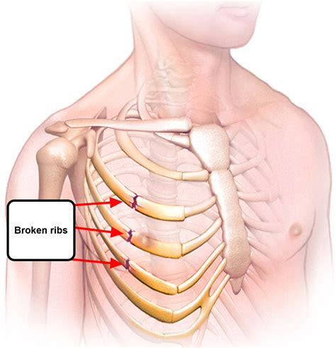 Broken Rib - Causes, Signs, Symptoms, Recovery Time & Treatment