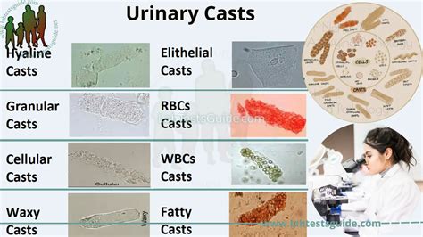 Hyaline Casts: What Are They, Causes, Diagnosis, Treatment,, 42% OFF