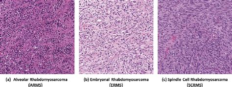 Figure 1 from Rhabdomyosarcoma Histology Classification using Ensemble of Deep Learning Networks ...