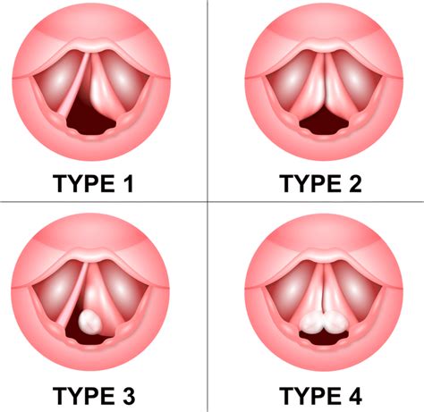 Graphical representation of our proposed classification for Reinke’s ...