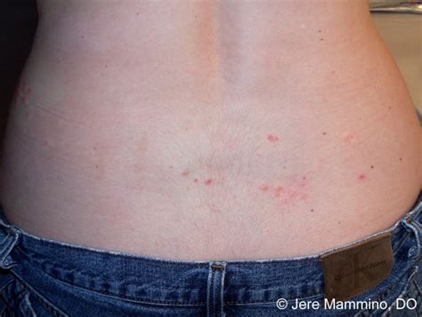 Chiggers - American Osteopathic College of Dermatology (AOCD)