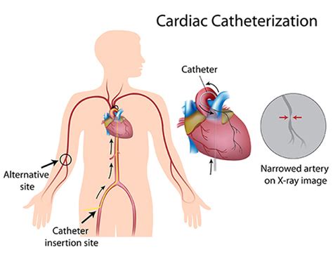 Angiogram vs Angioplasty - Patient Care for Pre and Post Operation