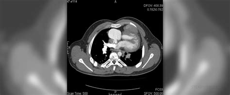 Surgery for pulmonary atresia | General center | SteadyHealth.com