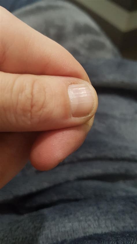 I have some grooves in my nails and they are not dissapearing even when ...