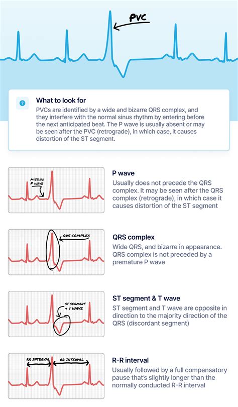 What Does A Pvc Look Like On An Ecg Strip at Donna Lane blog