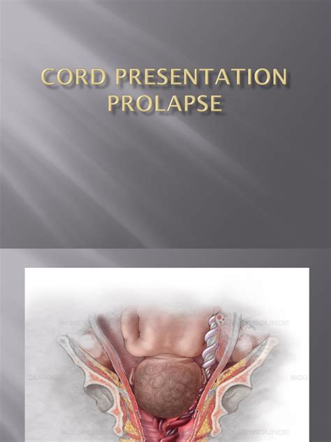 Cord Presentation Prolapse | PDF | Fetus | Mammalian Pregnancy